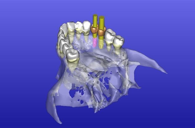 Nassau Dentist Uses New Technology for Tooth Implants
