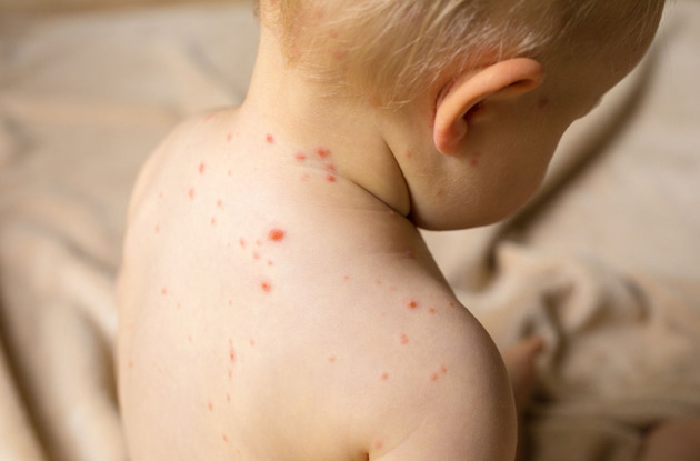 What Kind of Rash Does My Baby Have?