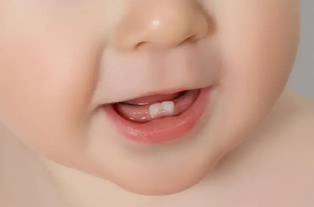 Can Your Baby's Teeth Predict Autism?